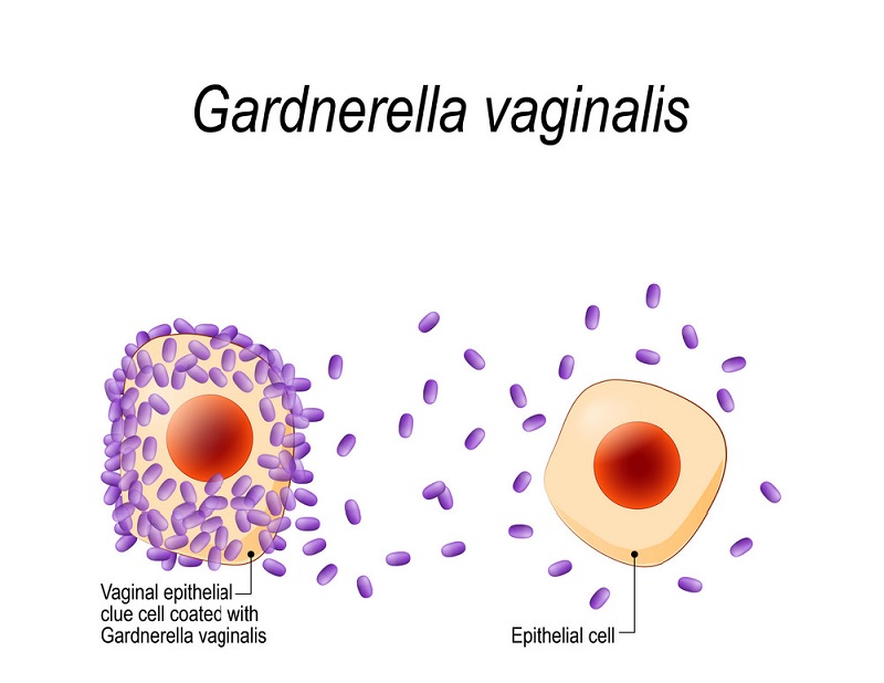 G.vaginalis tăng sinh (trái) và bình thường (phải) ở tế bào biểu mô âm đạo